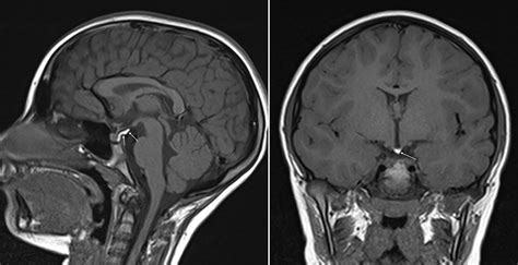 Pituitary Tumor Mri