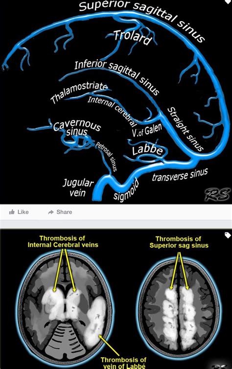Inferior Sagittal Sinus Mri
