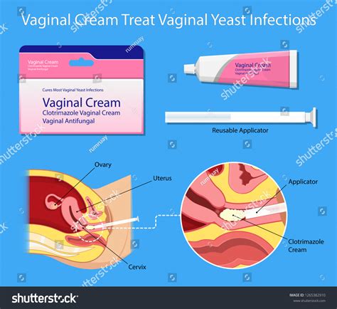 Vaginal Yeast Infection Symptoms Treatment – UKOBBQ