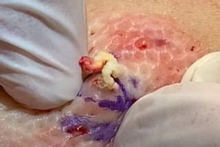 Image result for Awesome Exploding Cyst