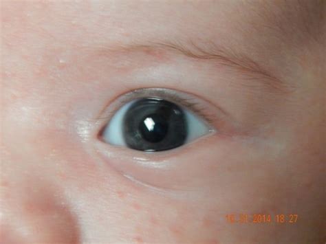 eye freckles (choroidal nevus) | BabyCenter