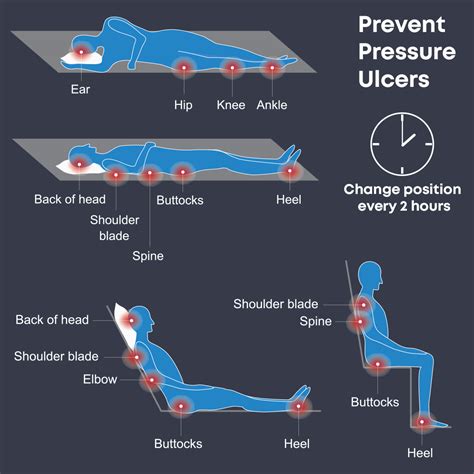 Prevent Bed Sores Pressure Ulcers (pressure Sores) NHS