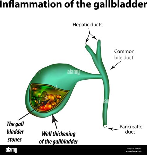 Inflamed Gallbladder Symptoms
