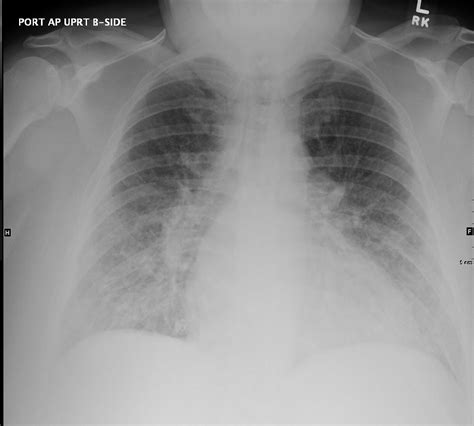 Kerley B Lines Labeled
