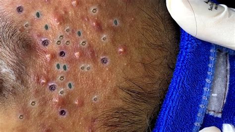 Image result for Worst Exploding Pimple