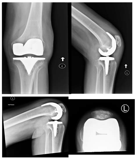 Alignment And Balance Methods In Total Knee Arthroplasty at Paul Dellinger blog