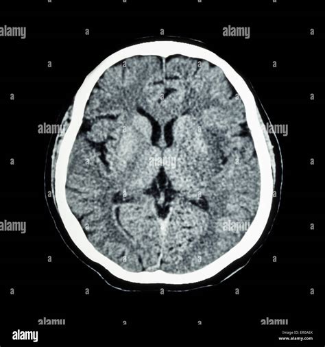 Normal Brain Ct Anatomy