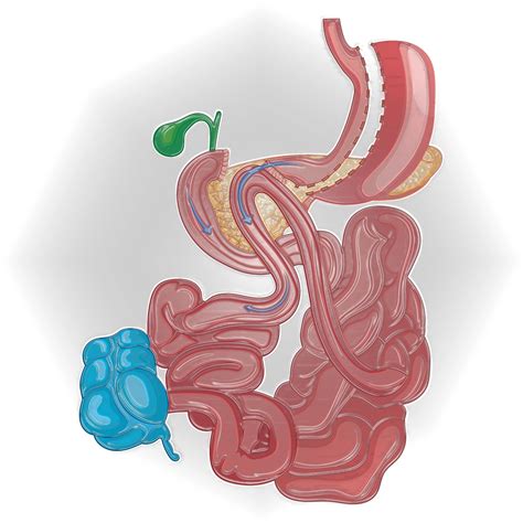 Malabsorptive Procedures (SADI-S) and Updated Surgery Guidelines
