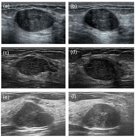 Differentiation between Phyllodes Tumors and Fibroadenomas through Breast Ultrasound: Deep ...