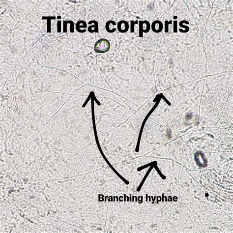Tinea Corporis Microscopic