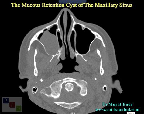 Health Zone Turkey: In Which Situations Is Paranasal Sinus Tomography Required Before The Nasal ...