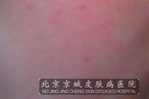 皮肤过敏有哪些表现_过敏_北京京城皮肤医院(北京医保定点机构)
