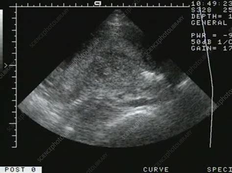 Ultrasound 的图像结果