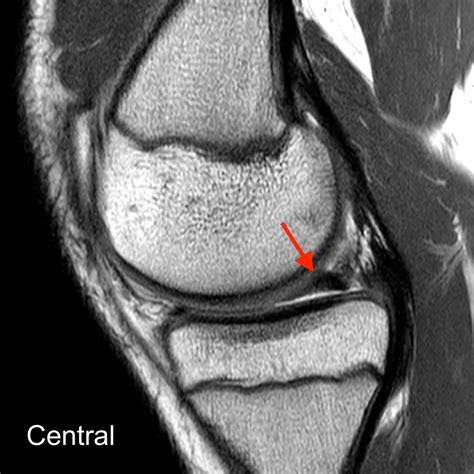 Bucket Handle Tear Meniscus Radsource at Genevieve Tarrant blog