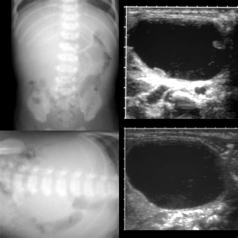 Newborn with a palpable abdominal mass | Pediatric Radiology Case | Pediatric Imaging ...