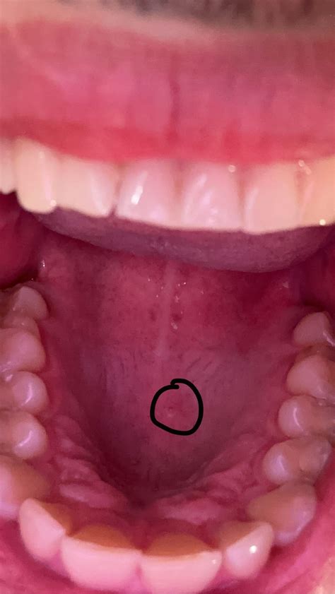 Small bump on the roof of mouth that seems to be brought on by eating ...
