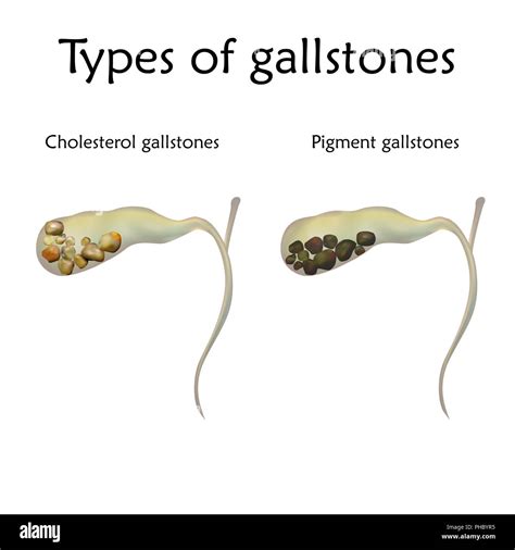 Difference Between Kidney Stone and Gallstone