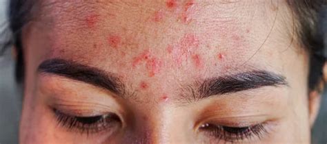 Small Bumps On Forehead: Meaning, Causes, Treatment | The Pink Foundry
