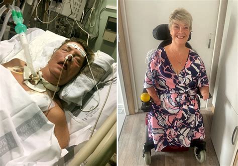 Woman has all of her limbs amputated after developing sepsis from ...