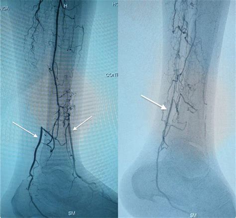 Resistance Index as a Prognostic Factor for Patency in Distal Lower ...