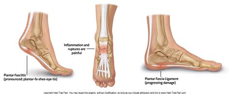 Plantar Fasciitis 的图像结果