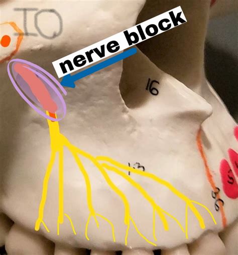 Local Infiltration Anesthesia 的图像结果