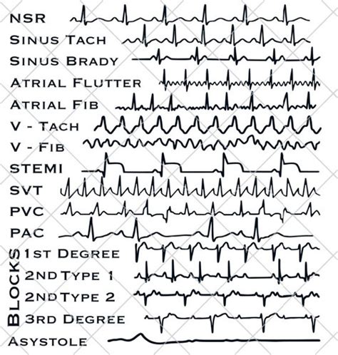 Image result for Telemetry Practice