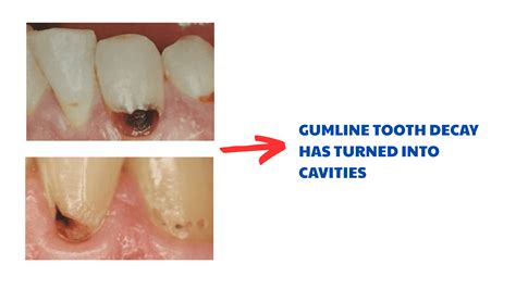 My Teeth are Decaying at the Gum Line: What You Need to Know