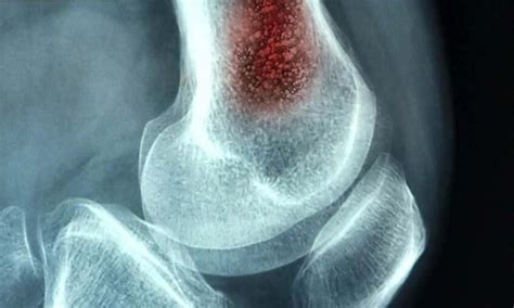 Diagnosis and management of bone infections in children: PIDS-IDSA ...