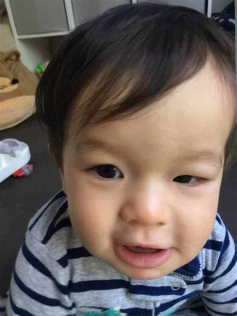 Symptoms of Allergic Reactions in Babies - Solid Starts