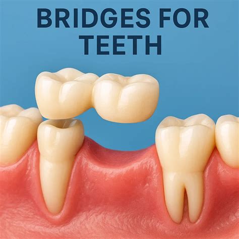 What Are Bridges for Teeth and How Do They Work?