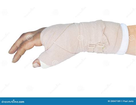 Broken Wrist Cast