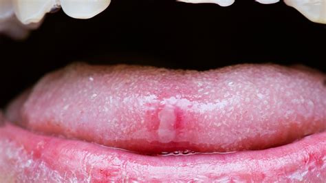Canker Sore On Lip Vs Herpes