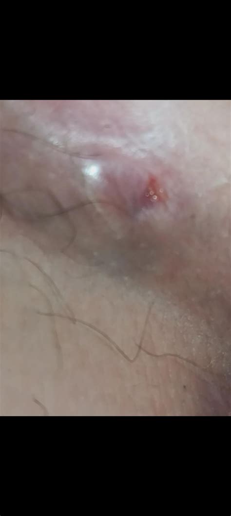 Lump near groin m22 : r/medical