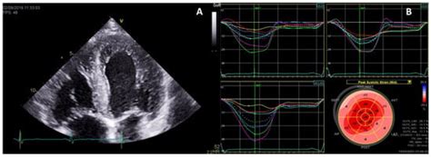Fabry Disease and the Heart: A Comprehensive Review