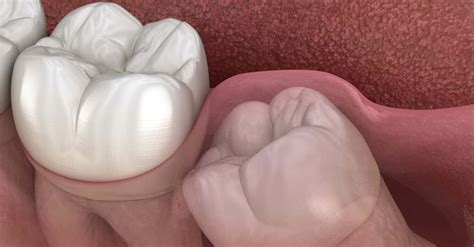 7 Signs You Need Your Wisdom Teeth Removed