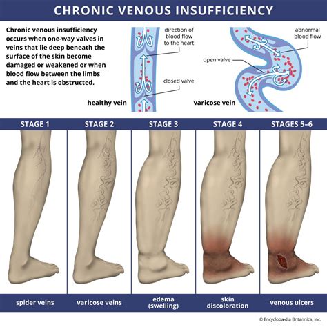 Is Chronic Venous Insufficiency Fatal