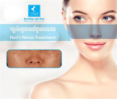 Laser Hori's Nevus Treatment - VNAT Clinic