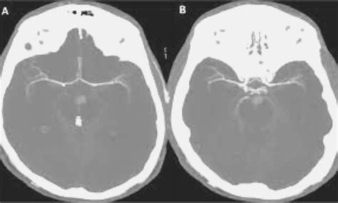 Use cerebral CT angiography to support clinical diagnosis of death ...