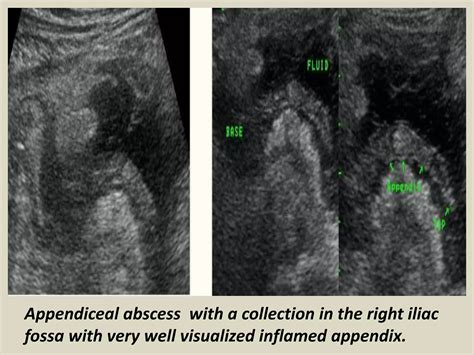 Presentation1.pptx, ultrasound examination of the appendix. | PPTX