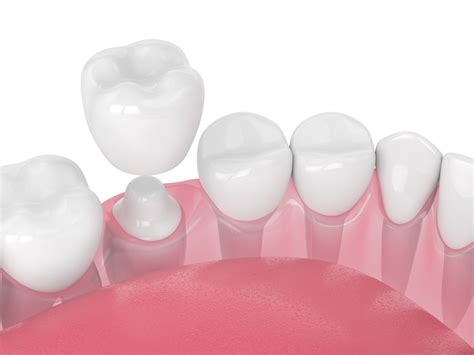 Dental Crowns Pompano Beach FL Dentist | JB Dentistry