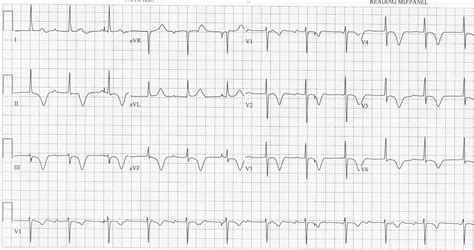 Ekg Rhythms - EKG Heart Rhythms Cheat Sheet - NCLEX Quiz - asaaqaafiyah