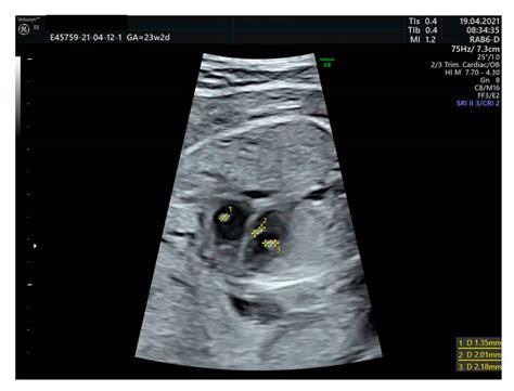 21 Week Ultrasound Down Syndrome