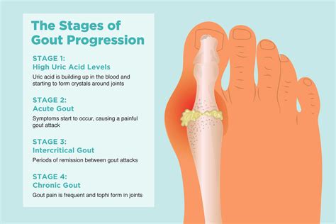 How to Recognize the Signs of Gout