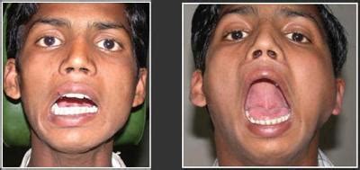 Low Cost Lock Jaw Treatment In Hyderabad - Health, Beauty & Fitness ...