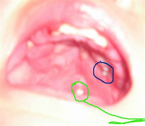 口腔黏膜小白点图片