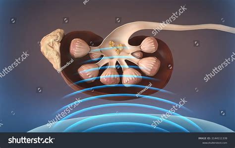 Lithotripsy Procedure 的图像结果