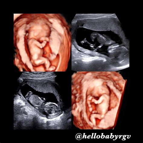 Hello Baby! | 13 weeks gestation 🤗🥰😍😊 2D/5D ultrasound @hellobabyrgv ...