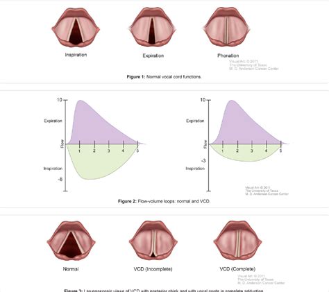 Figure 2 from Vocal Cord Dysfunction: An Updated Review | Semantic Scholar