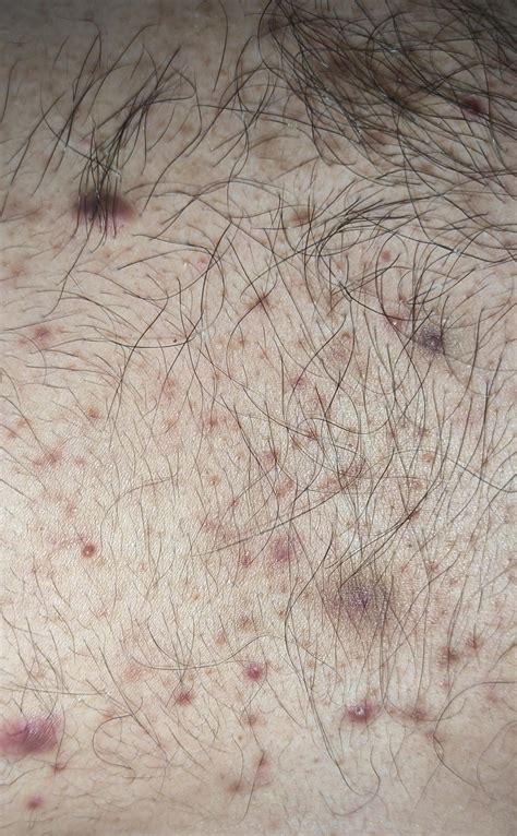 Big pimples/lump on chest,shoulder and back. 23M : r/SkincareAddicts